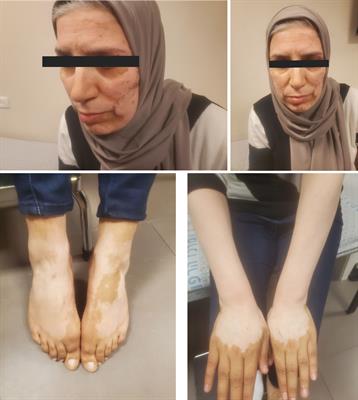 Acrofacial vitiligo secondary to PI3KCA inhibitor, alpelisib: case report